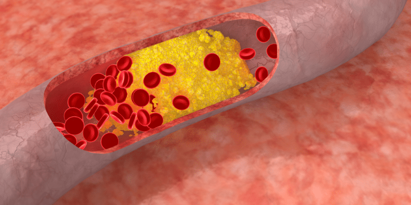 Cholesterolis